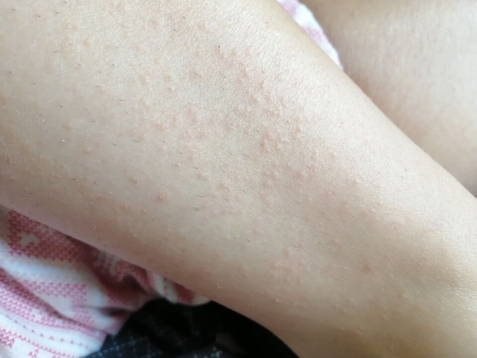 Redness on Elena's legs before using Germivir tablets