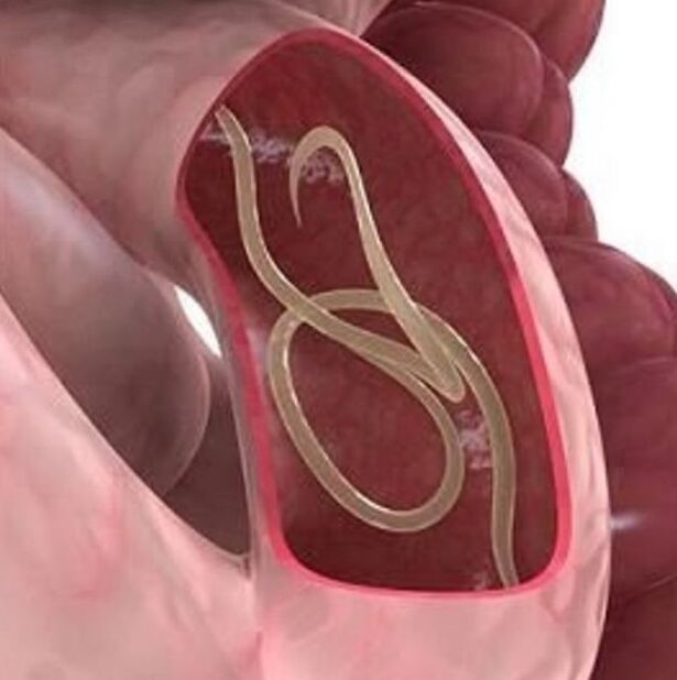 Signs of worms in a person in the gastrointestinal tract